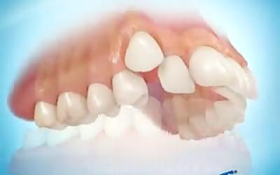 ارتودنسی همراه با کشیدن دندان دائمی