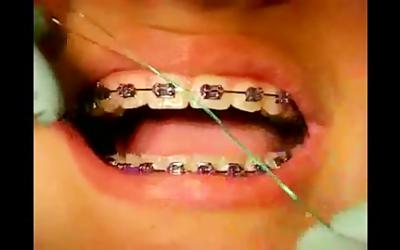 کشیدن نخ دندان در بیماران ارتودنسی