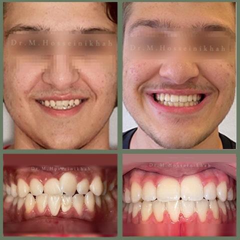 درمان بی نظمی دندانها بدون کشیدن دندانهای دائمی