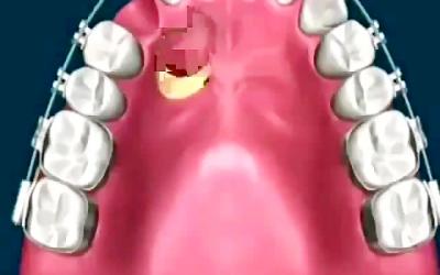 درمان ارتودنسی دندان های نیش نهفته