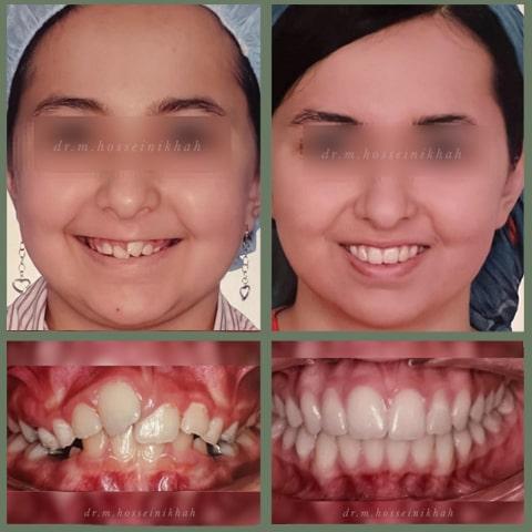  درمان بی نظمی با گسترش قوس بدون کشیدن دندان‌های دائمی