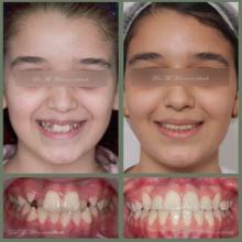 درمان بی نظمی دندانها بدون کشیدن دندانهای دائمی